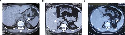 Case Report: Three Rare Cases of Ectopic ACTH Syndrome Caused by Adrenal Medullary Hyperplasia